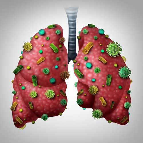 Bronchitis or pneumonia