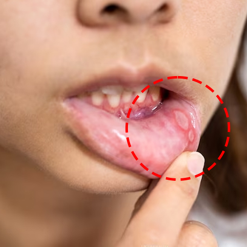 Persistent mouth sore 