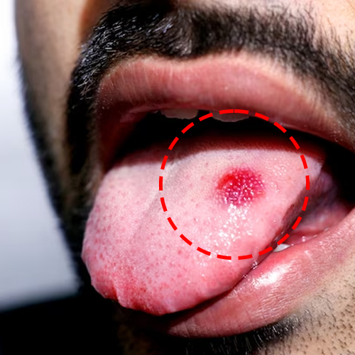 Red or white patches on the tongue, gums