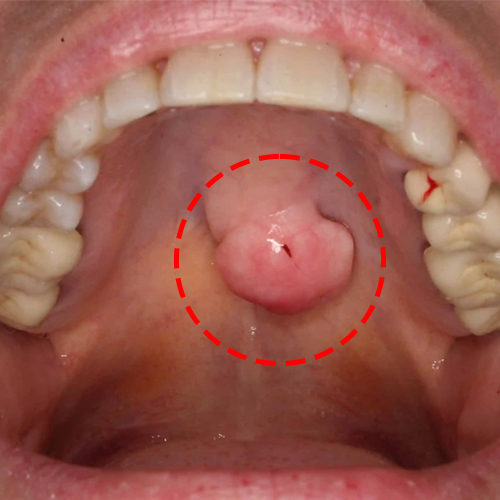 Swelling or lumps in the mouth