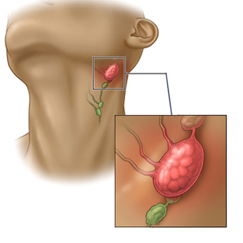 Enlarged Lymph Nodes