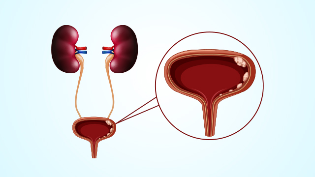 Bladder Cancer Symptoms and Causes