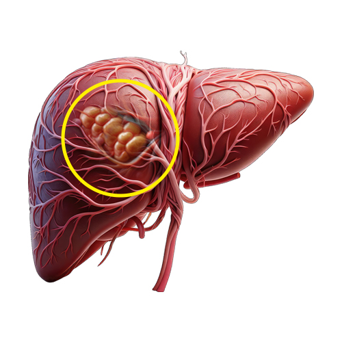 hepatocellular carcinoma