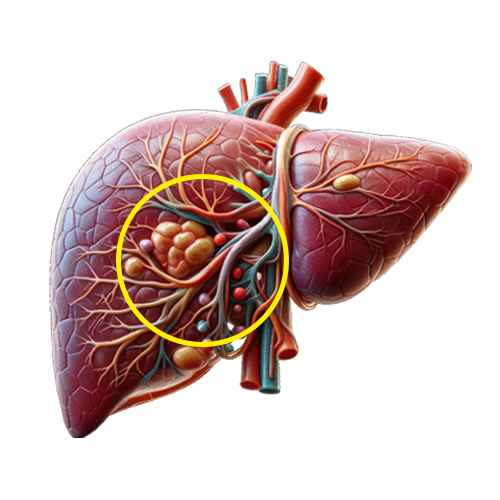 Intrahepatic cholangiocarcinoma