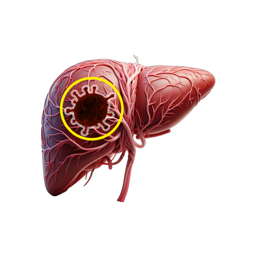 Angiosarcoma