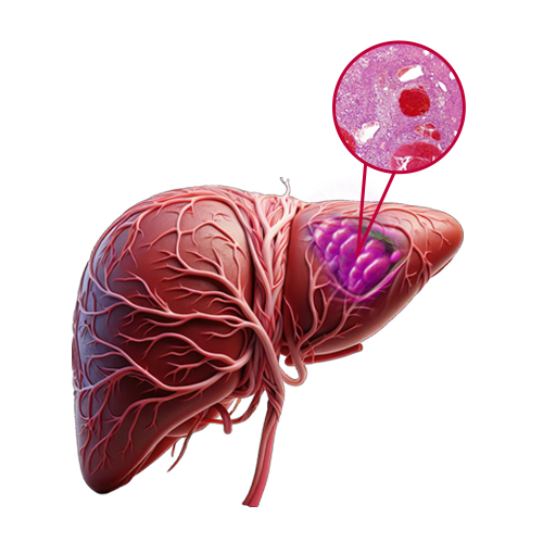 Hemangiosarcoma