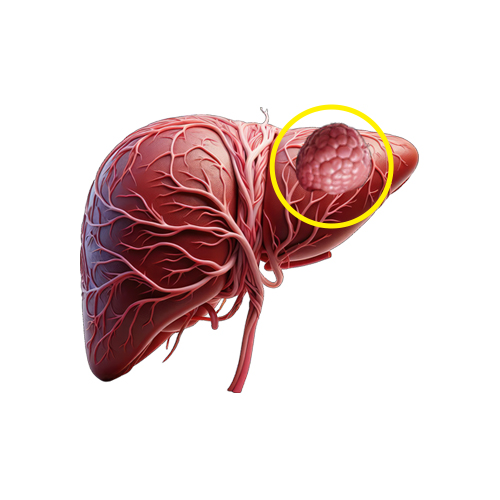 Hepatic adenoma