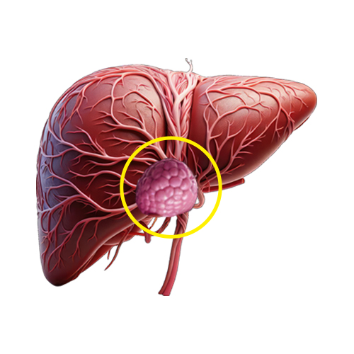 Focal nodular hyperplasia