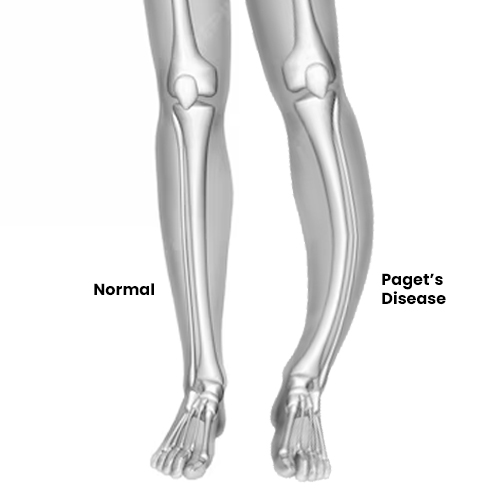 Paget's Disease