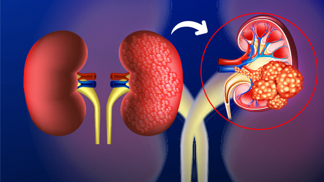 The Ultimate Natural Way of Kidney Cancer Management 